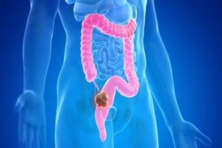 Colorectal Cancer