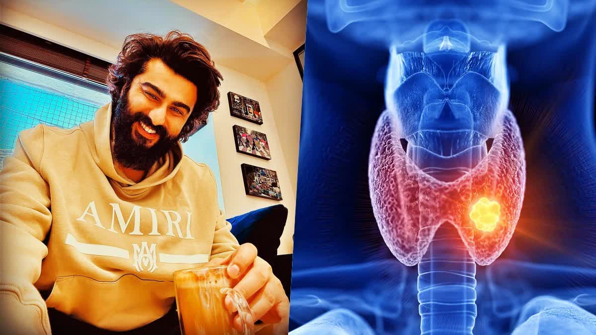 ഹാഷിമോട്ടോസ് തൈറോയ്‌ഡൈറ്റിസ്  ARJUN KAPOOR HASHIMOTOS THYROIDITIS  HASHIMOTOS THYROIDITIS SYMPTOMS  HASHIMOTOS DISEASE