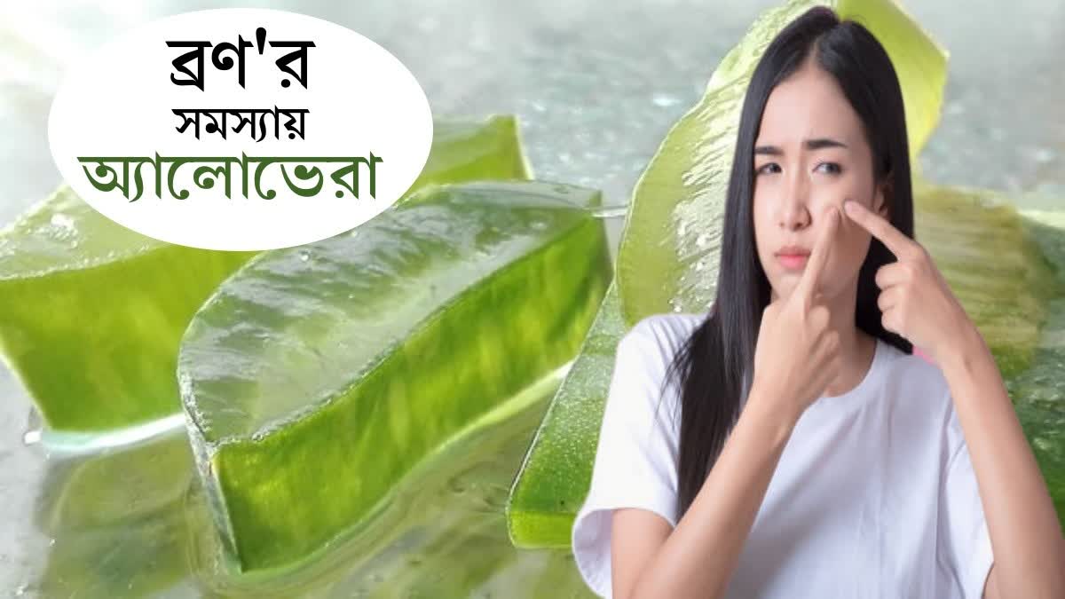 Aloe Vera For Acne News