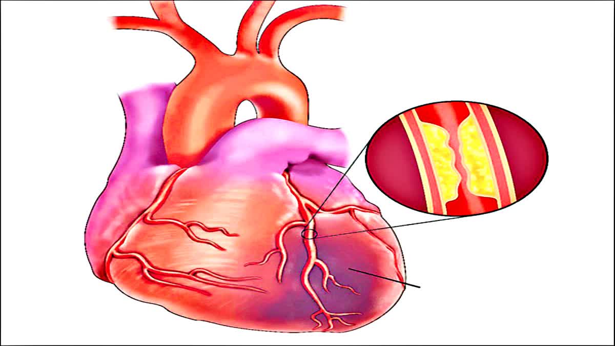 how to prevent cardiac arrest . Heart disease symptoms . cardiac arrest . Cardiovascular diseases . precautions for cvd