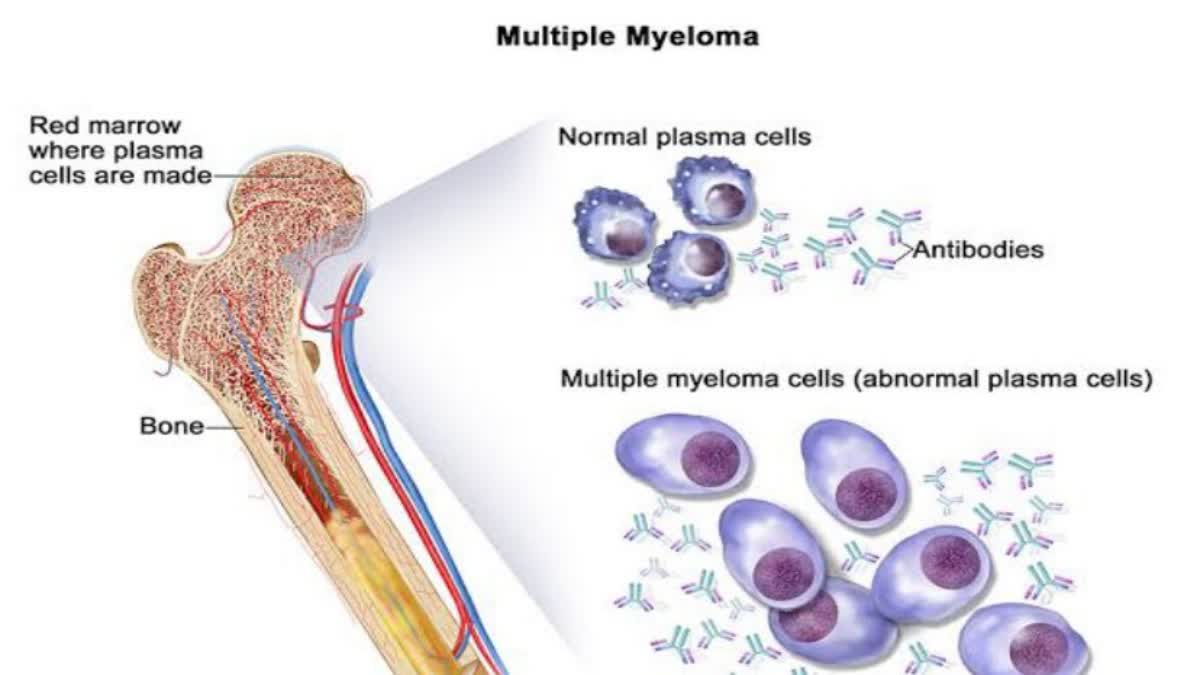 Cancer Specialist On what is multiple myeloma ways to avoid