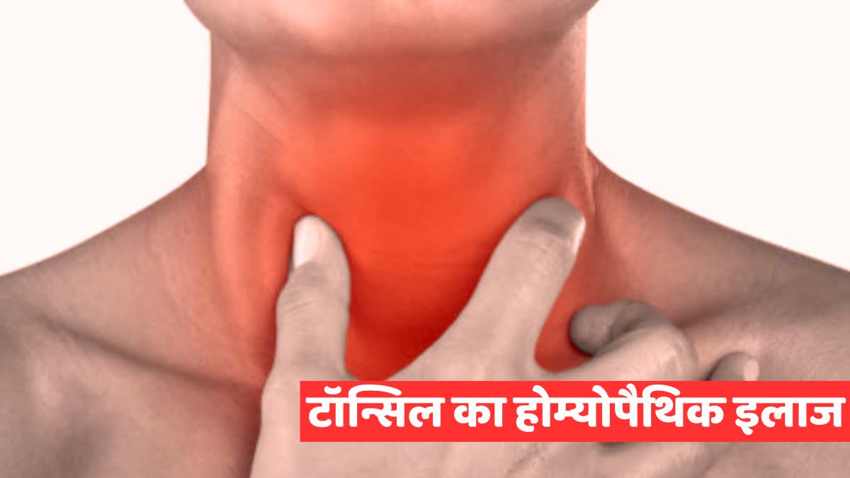 Treatment of Tonsils in Homeopathy