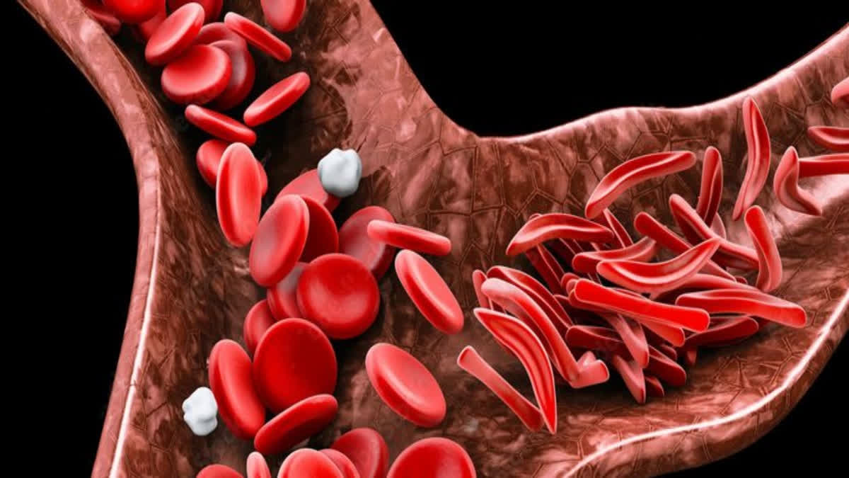 ICMR issues standard treatment guidelines for sickle cell disease