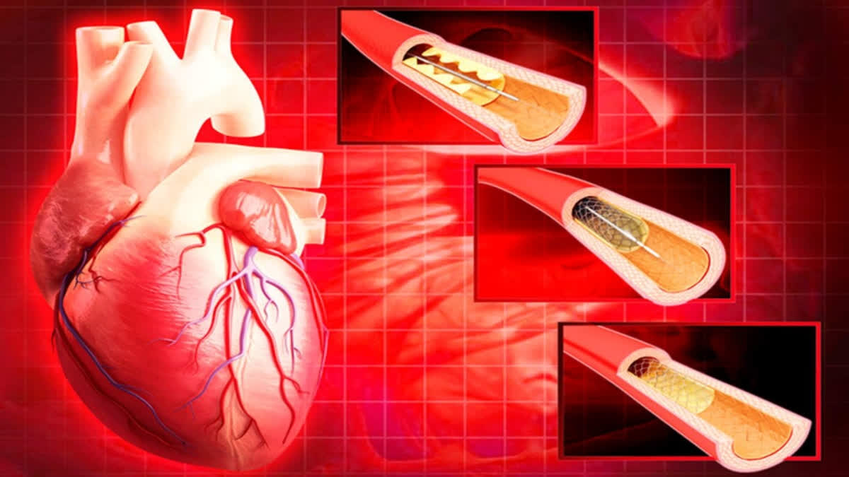 Laser therapy techniques being preferred over stents to remove vein blockages