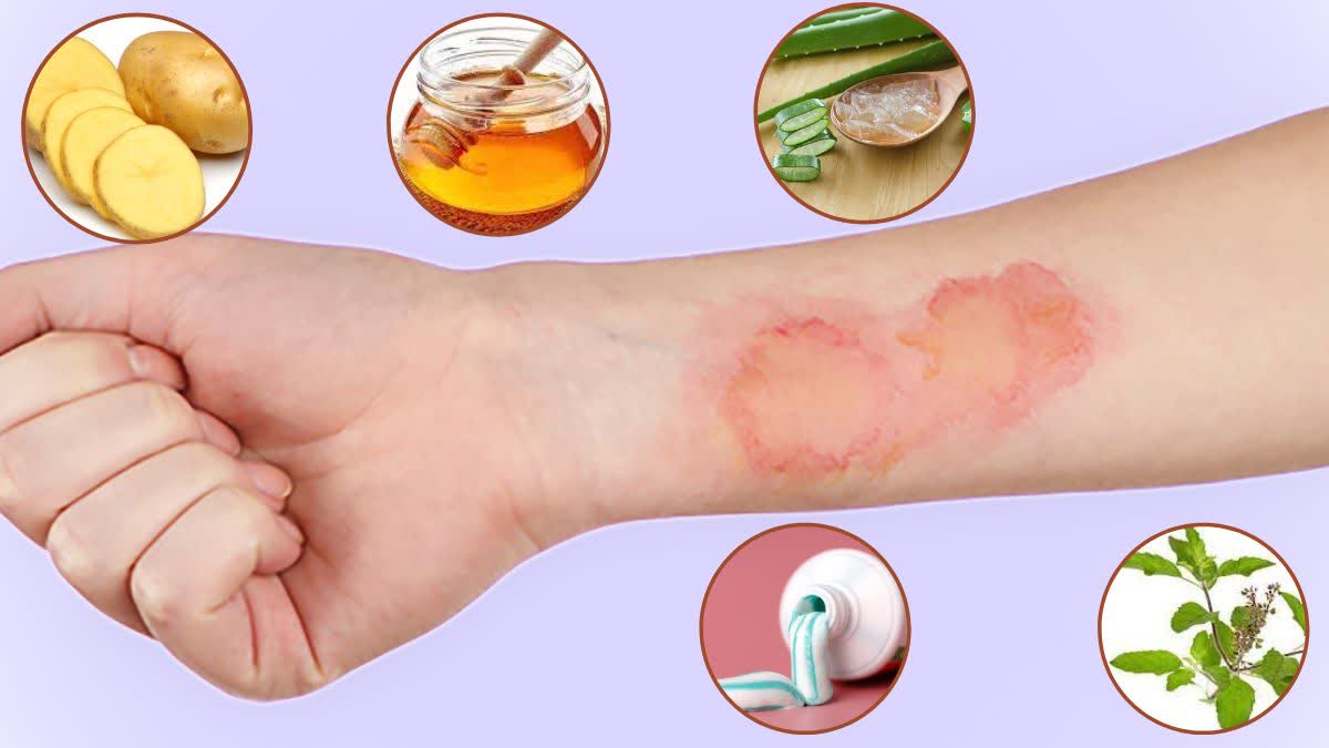 Home Remedies For Burns