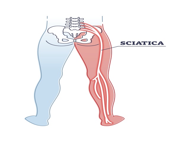 sciatica pain, physiotherapy in sciatica pain, sciatica exercise