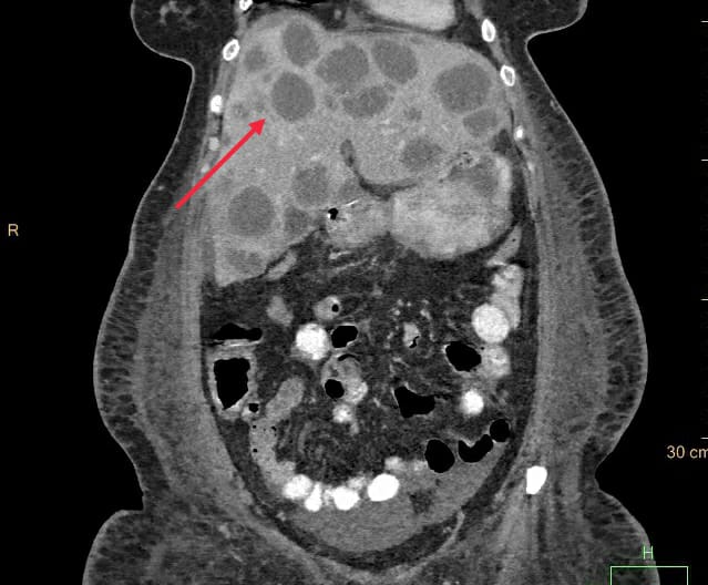 liver abscess patient sir ganga ram hospital