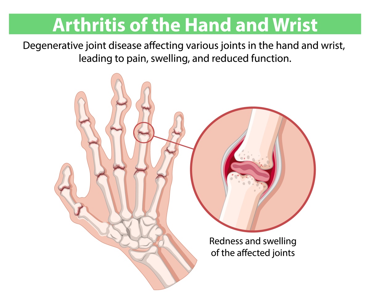 Illustration of RA in the hand and wrist