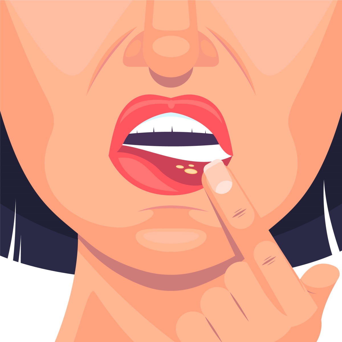 Lip cancer illustration