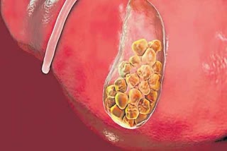 gall bladder stone surgery