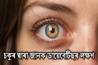 These 6 changes in the eyes indicate diabetes