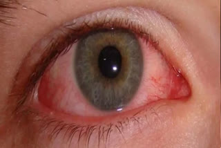 CONJUNCTIVITIS RED EYES