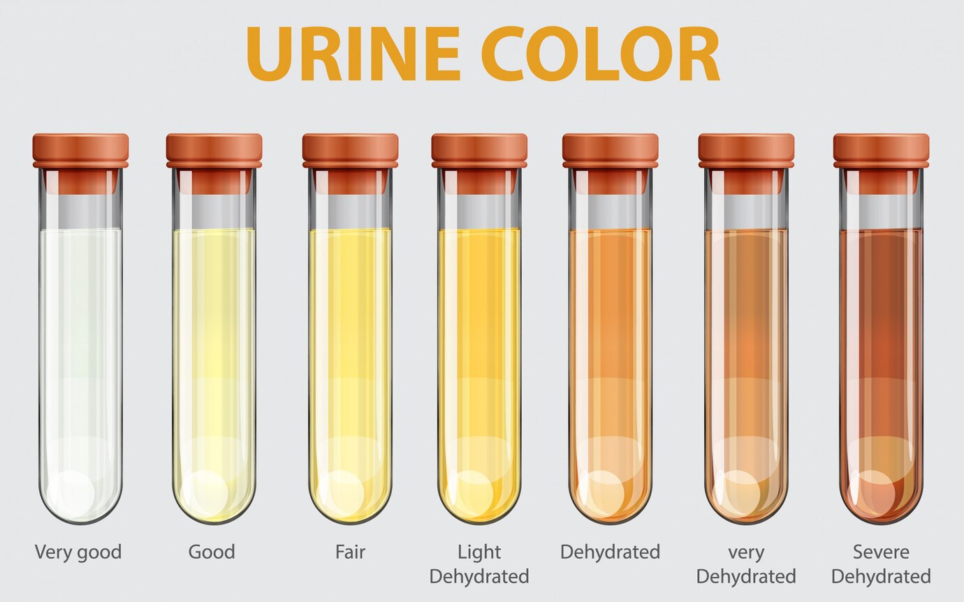 These symptoms of urine indicate that uric acid has increased in Your Body