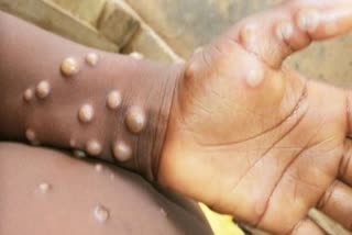 WHO approves first mpox vaccine