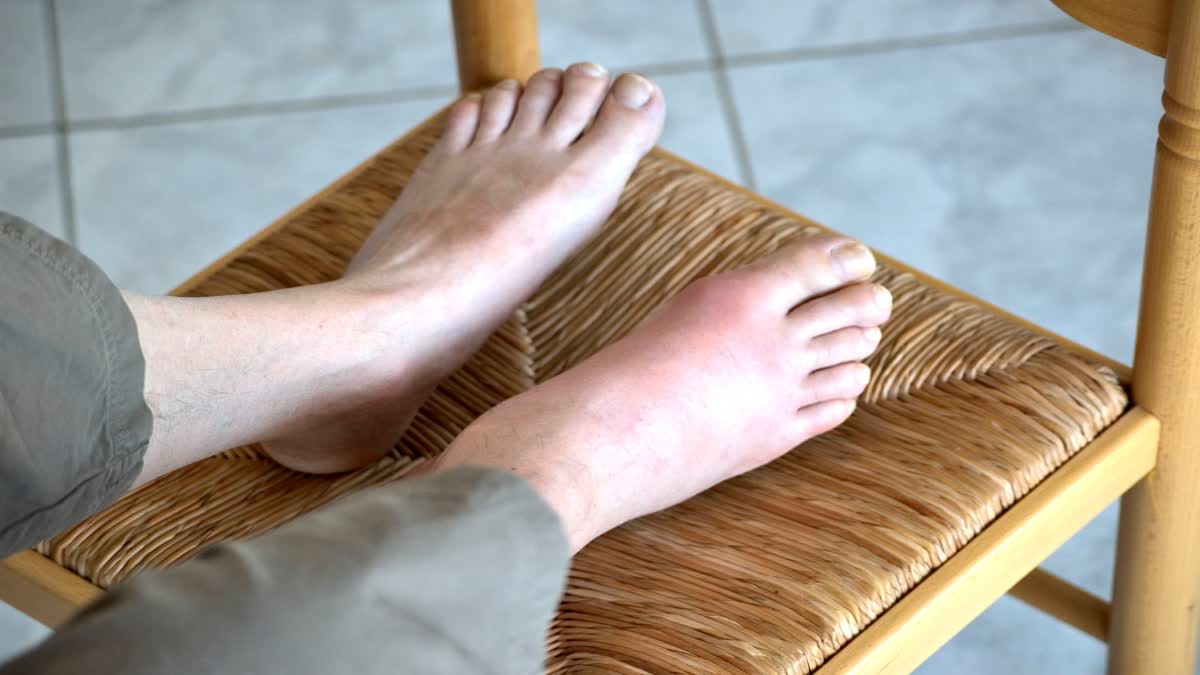 Swelling Feet Home Remedies