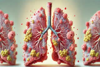 CAP is a type of lung infection