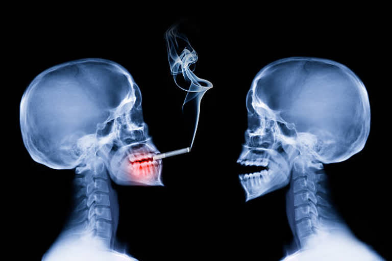 Smoking likely leads to permanent brain shrinkage showed Washington University School of Medicine Study