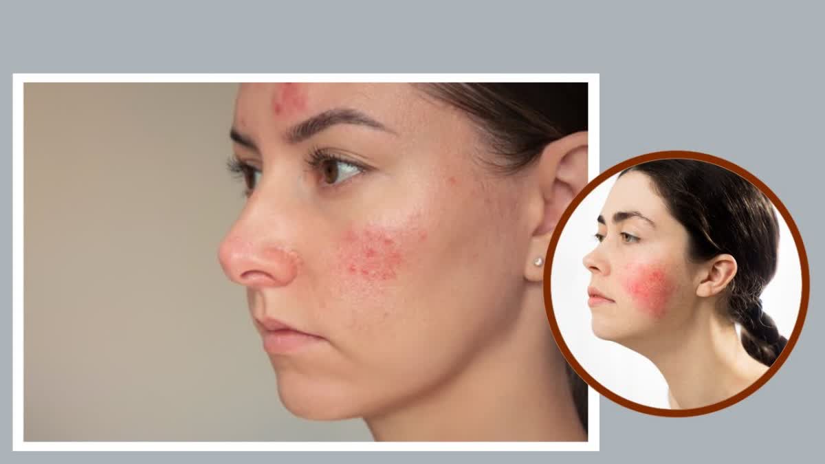 Rosacea Causes and Symptoms in Telugu