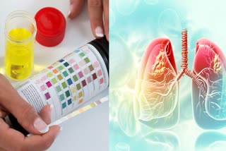 Lung Cancer Detection Using Urine Test