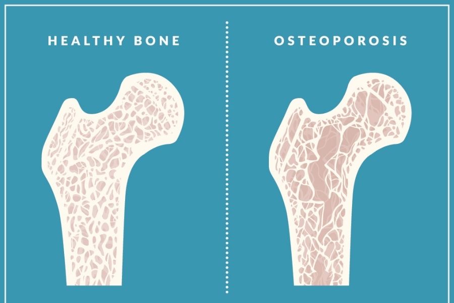 osteoporosis, osteoporosis day, world osteoporosis day, what is osteoporosis, what are the symptoms of osteoporosis, what is the treatment for osteoporosis, bone health, bone health tips, how to keep bone healthy, disease, bone disease,  calcium, why is bone health important, what are the causes of osteoporosis, who is at risk of osteoporosis