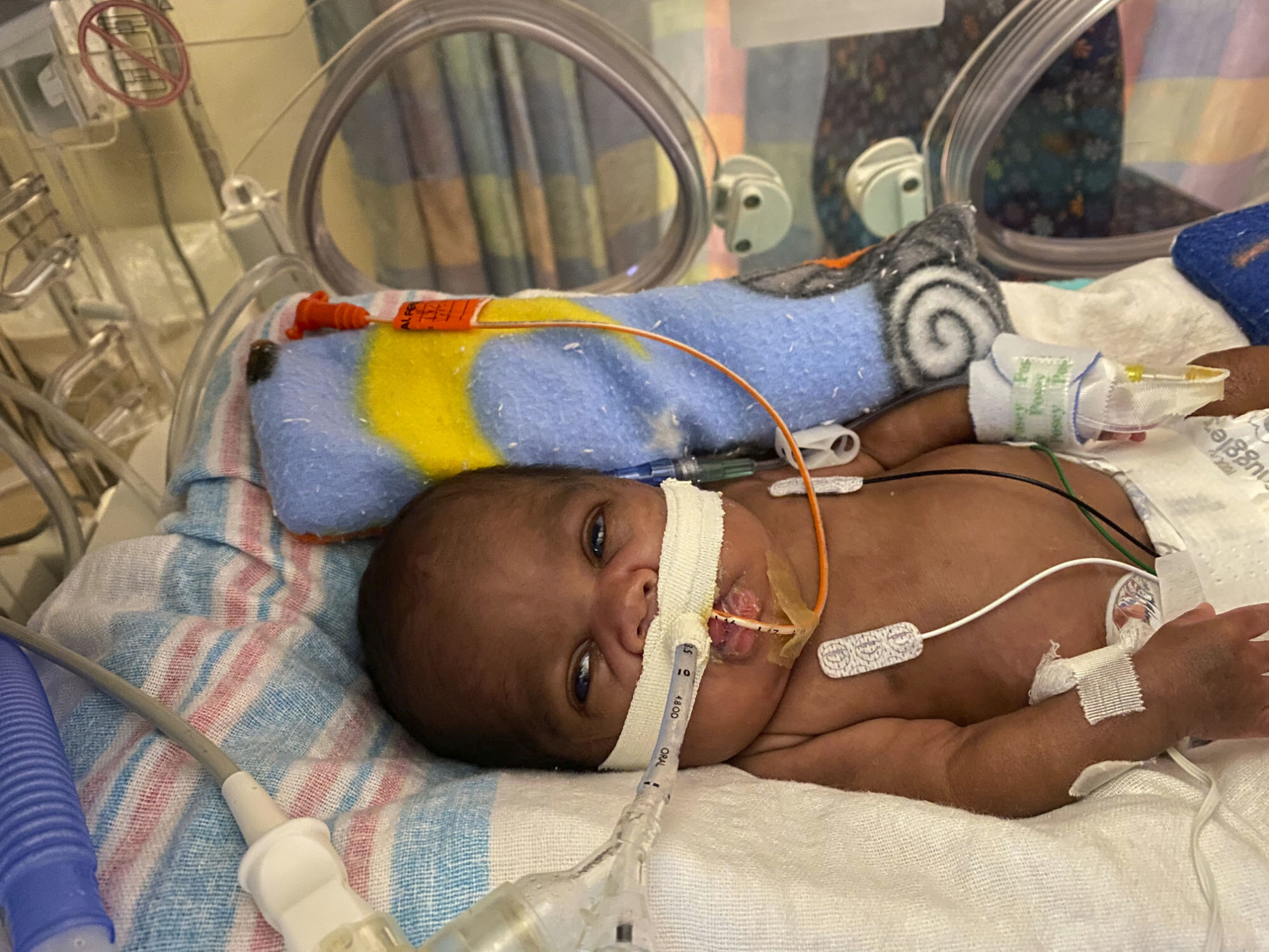 Alabama boy born in 21 weeks named world's most premature baby to survive