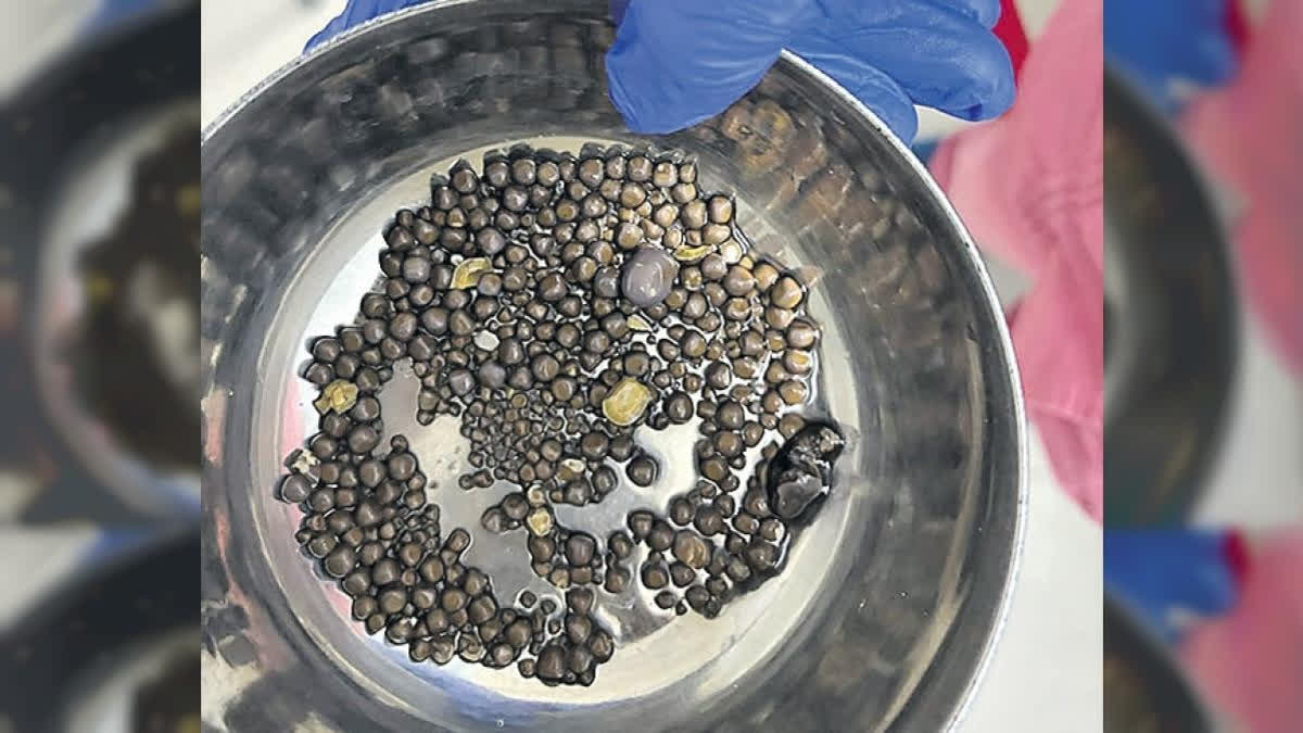 A team of urologists at the Asian Institute of Nephrology and Urology in Hyderabad removed 418 kidney stones from a 60-year-old patient who had a severely impaired kidney function of only 27 per cent.