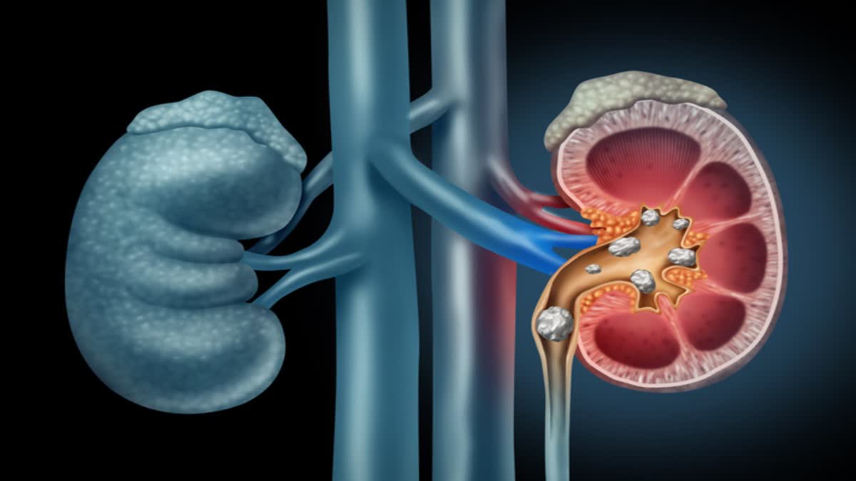 Kidney Stones Risk Shocking Facts