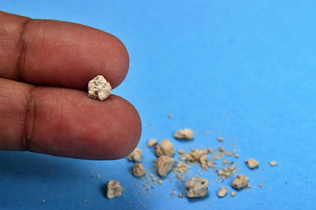 DELHI AIIMS ON KIDNEY STONE DELHI AIIMS REASONS OF KIDNEY STONE NEW RESERCH ON KIDNEY STONE