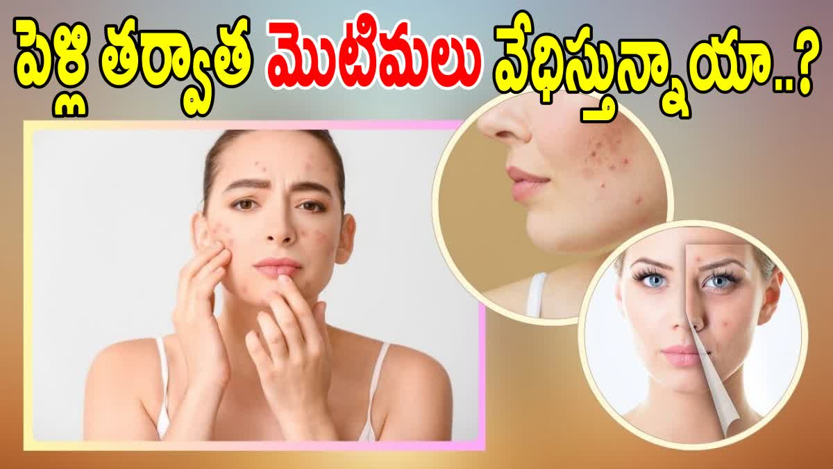 TIPS TO PREVENT ACNE PROBLEMS