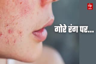 Etv Bharat