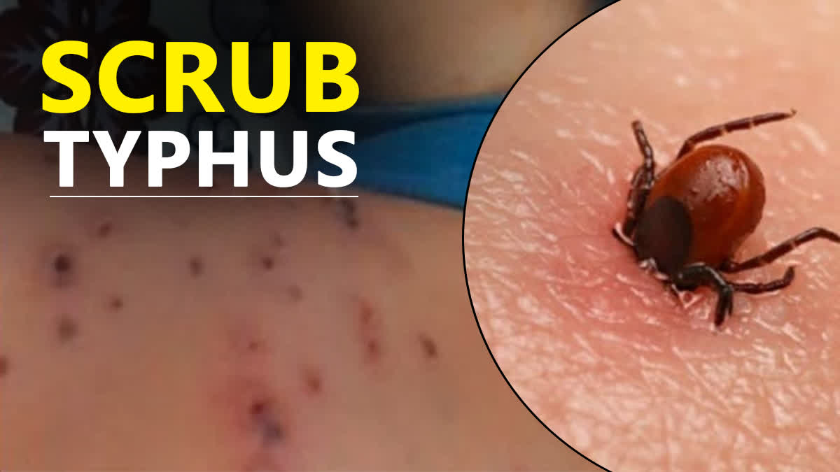 Scrub typhus cases in himachal