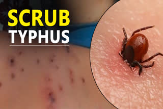 Scrub typhus cases in himachal