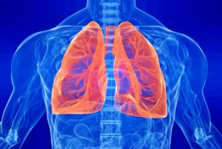 patients with mild covid infection may suffer from lung disease after one year