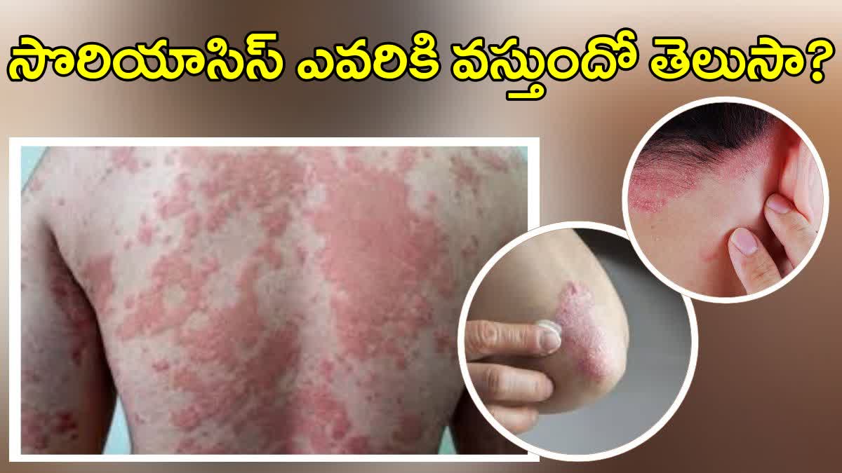 Psoriasis Symptoms and Treatment