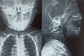 Doctors in Kolkata remove safety pin stuck in 5-month-old baby's trachea