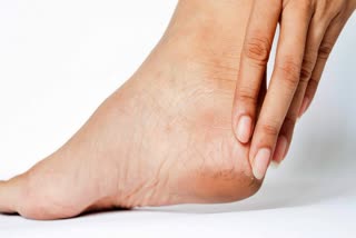 What deficiency causes cracked feet