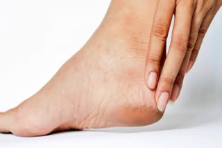 HOME REMEDIES FOR CRACKED HEELS  CAUSES OF CRACKED HEELS  NATURAL WAYS TO HEAL CRACKED HEELS  CRACKED HEELS TREATMENT