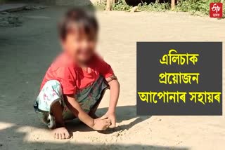 Child Affected with incurable disease in baksa barama