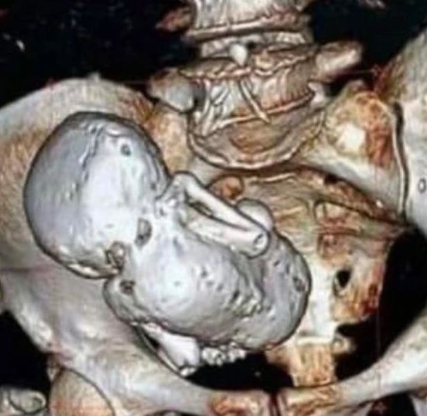 एक्स-रे रिपोर्ट में आई स्टोन बेबी की तस्वीर