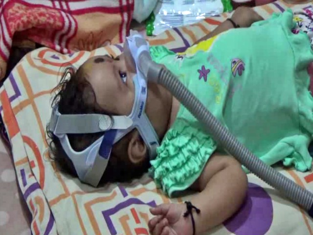 Haveri Child Suffering from Spinal muscular atrophy disease