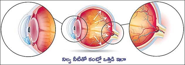 eye glaucoma