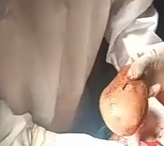 Half kg stone removed from woman's stomach