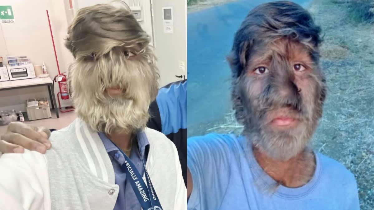 WEREWOLF SYNDROME LALIT PATIDAR