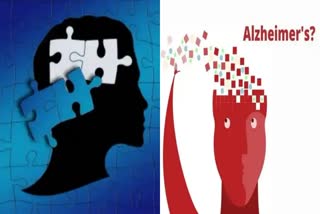 Alzheimer  Artificial Intelligence  health news  Alzheimers medicine