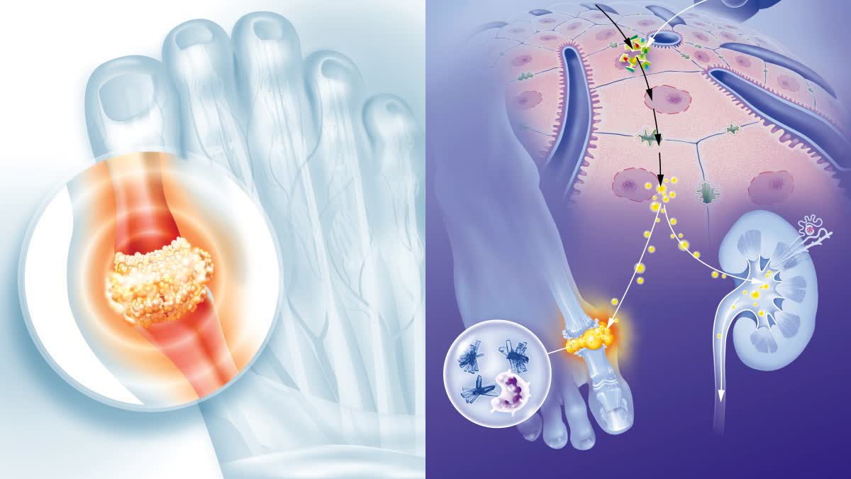 URIC ACID  ಯೂರಿಕ್ ಆ್ಯಸಿಡ್​ ಸಮಸ್ಯೆ  URIC ACID PROBLEM  AVOID EATING WHITE FOODS