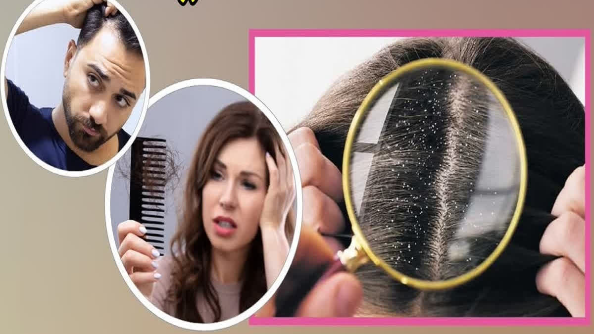 BEST WAYS TO STOP HAIR LOSS from Dandruff here is the tips to prevent