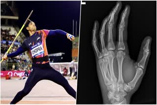 NEERAJ CHOPRA FRACTURED HAND