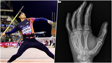 Neeraj Chopra fractured hand