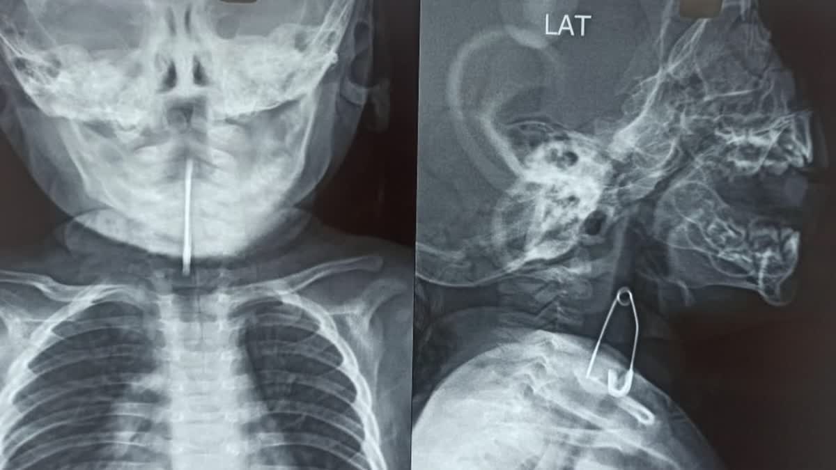 Rare surgery successfully brings out safety pin from 5-month-old's trachea in Calcutta Medical College