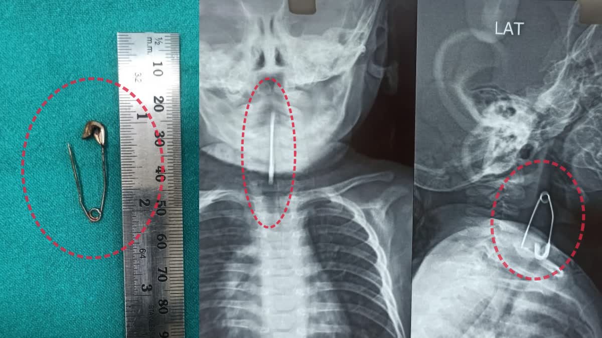 Safety Pin Stuck Boy Trachea